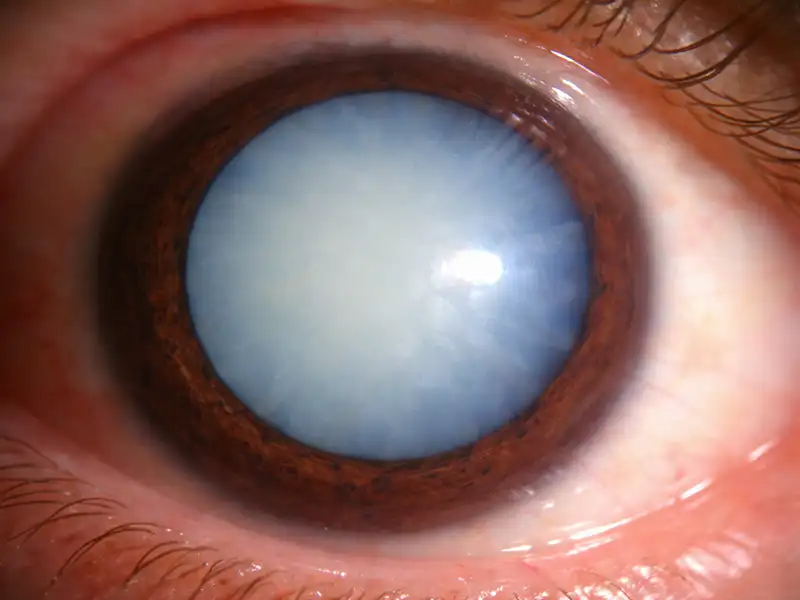 Cataract Cataract
