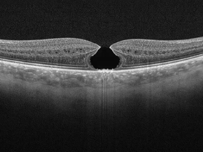 macular hole macular hole