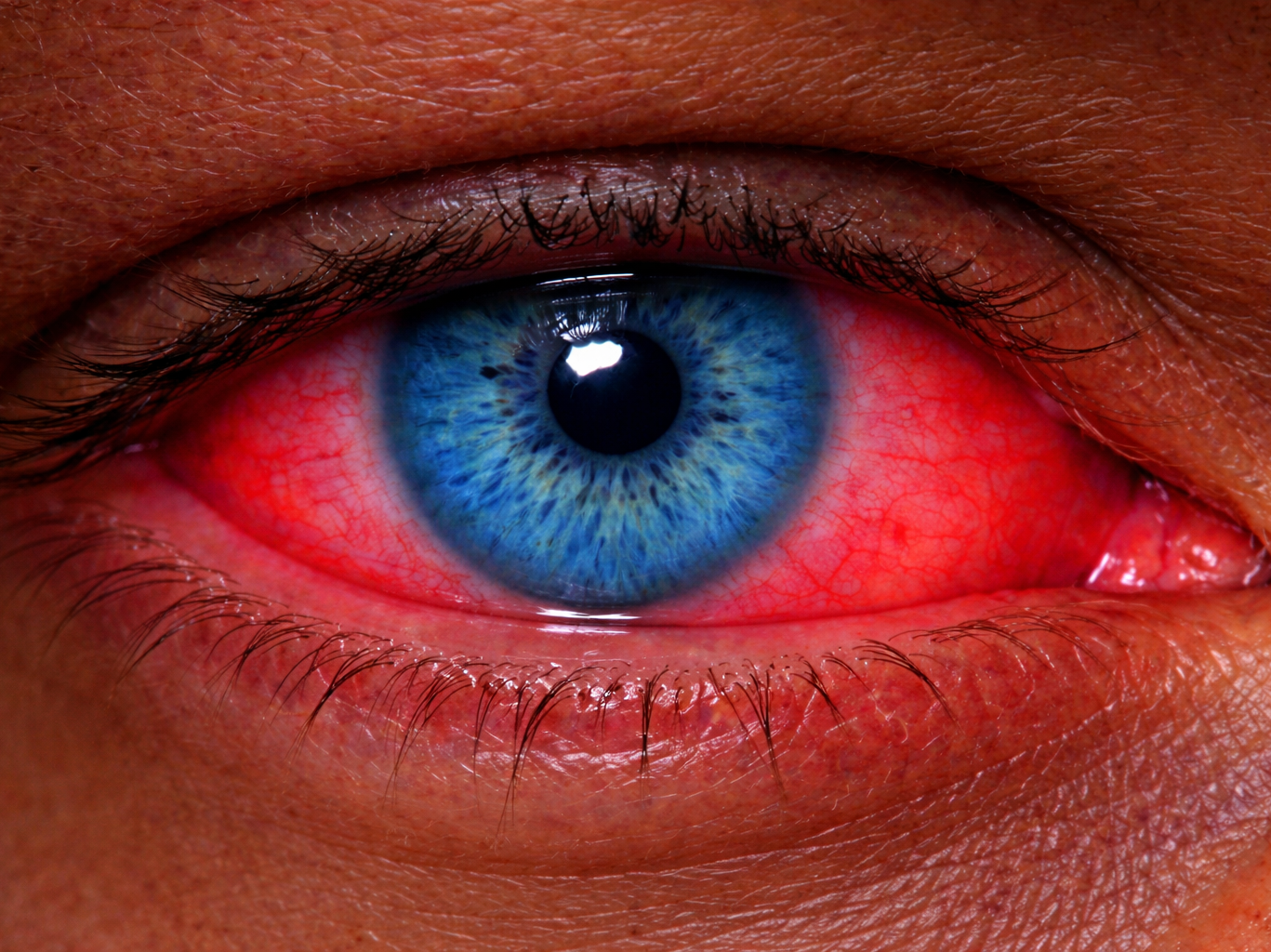 uveitis-1 uveitis
